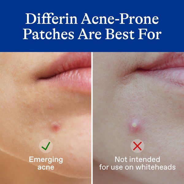 Differin Fast Fix Salicylic Acid Pimple Patches for Emerging Acne - 36ct