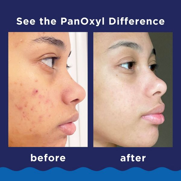 PanOxyl 10% Benzoyl Peroxide Acne Foaming Wash - 1oz