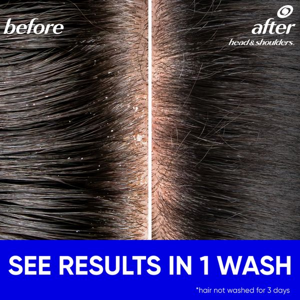 Head & Shoulders Dandruff Shampoo, Anti-Dandruff Treatment, Classic Clean for Daily Use, Paraben-Free - 20.7 fl oz