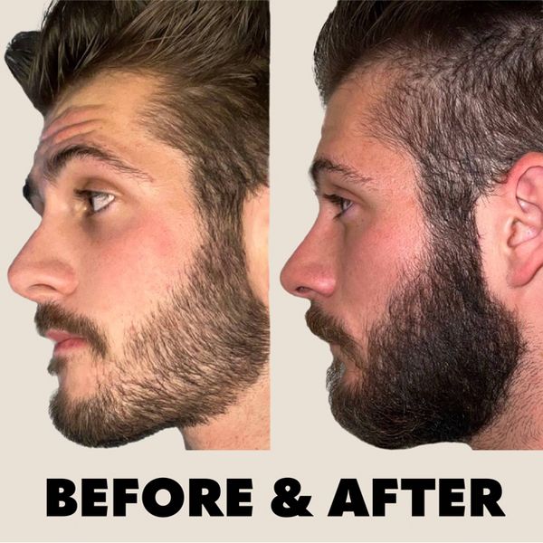 Beard Club Beard Derma Roller