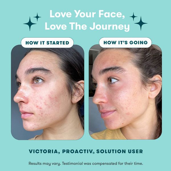 Proactiv Solution 30 Day Acne Treatment Kit - 5 fl oz/3pc