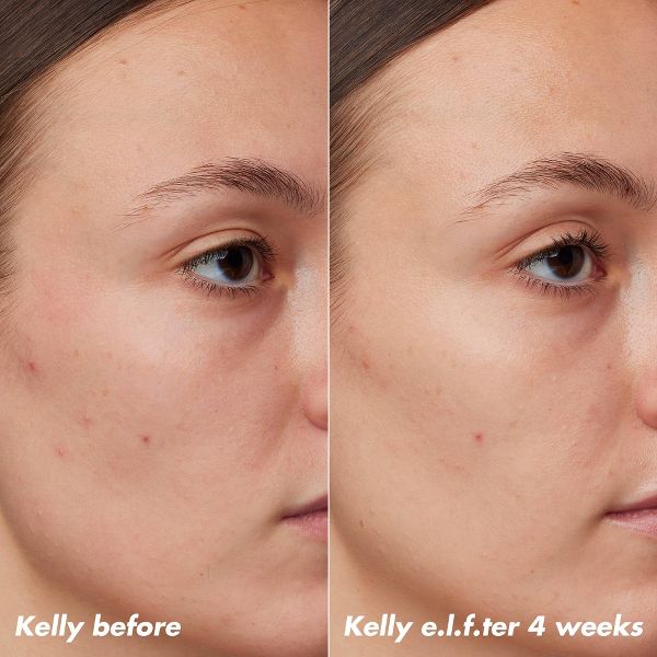 e.l.f. SKIN PLZ Clarify Facial Oil - 2% Salicylic Acid Acne Treatment + Aloe Extract - 1 fl oz