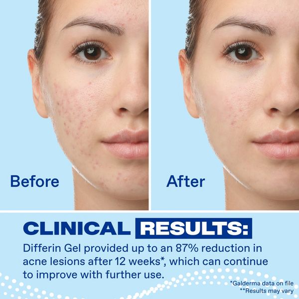 Differin Retinoid Adapalene Gel 0.1% Acne Treatment for Face and Body - 45g/1.6oz