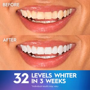 Crest 3D Whitestrips Professional White with Light Teeth Whitening Kit - 19 Treatments