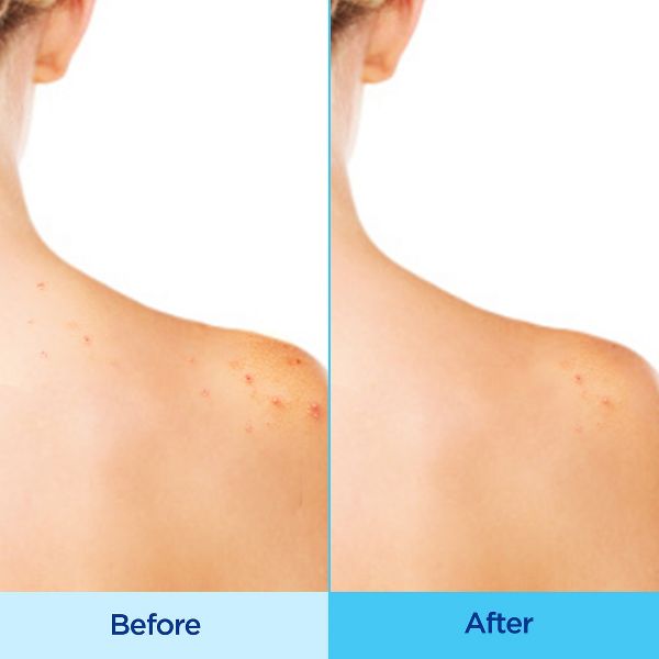 Differin Acne-Clearing Body Spray, 2% Salicylic Acid Acne Treatment - Unscented - 6oz