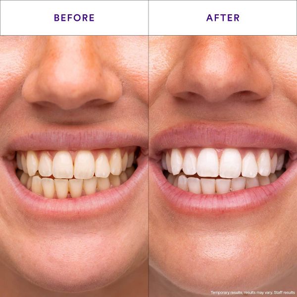 Hismile V34 Teeth Whitening Strips - 14pk
