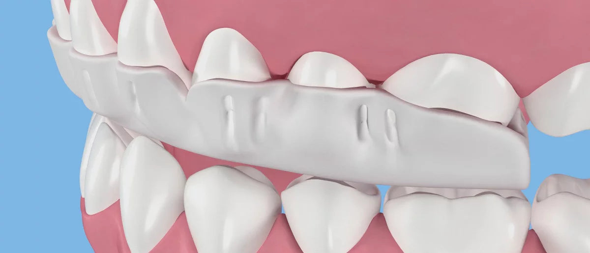 SleepRight ProRx Custom Full Coverage Dental Guard