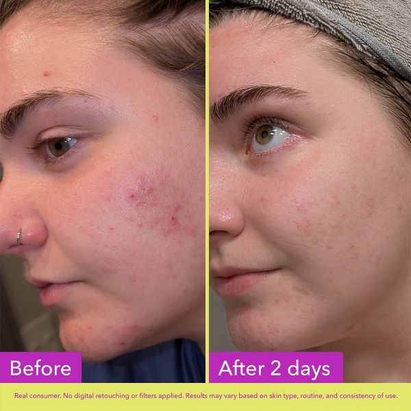 Good Molecules 10% Azelaic Acid Face Treatment - 30ml