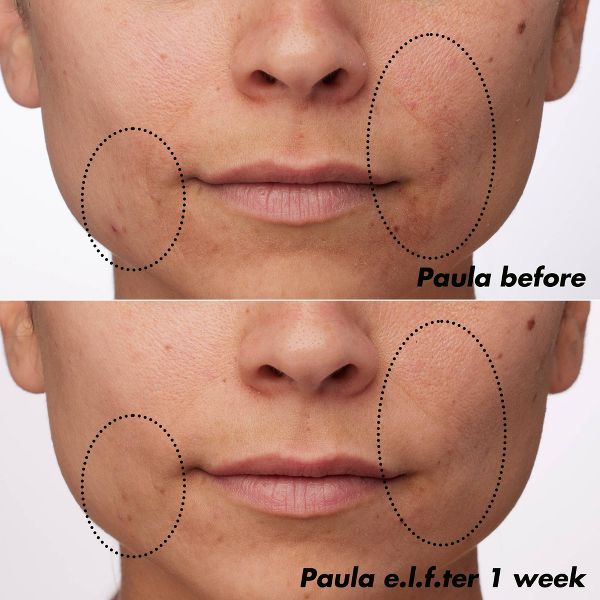 e.l.f. SKIN PLZ Clarify Facial Oil - 2% Salicylic Acid Acne Treatment + Aloe Extract - 1 fl oz