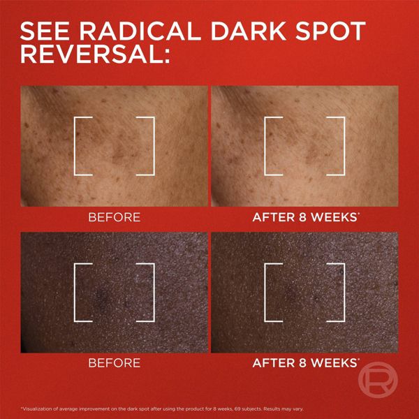 L'Oreal Paris Revitalift Triple Power Melasyl Dark Spot Moisturizing Creamy-Serum - 1.7 fl oz