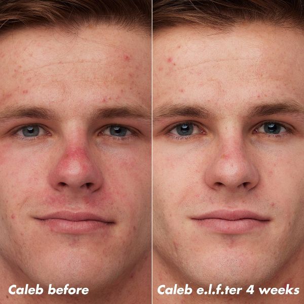 e.l.f. SKIN PLZ Clarify Facial Oil - 2% Salicylic Acid Acne Treatment + Aloe Extract - 1 fl oz