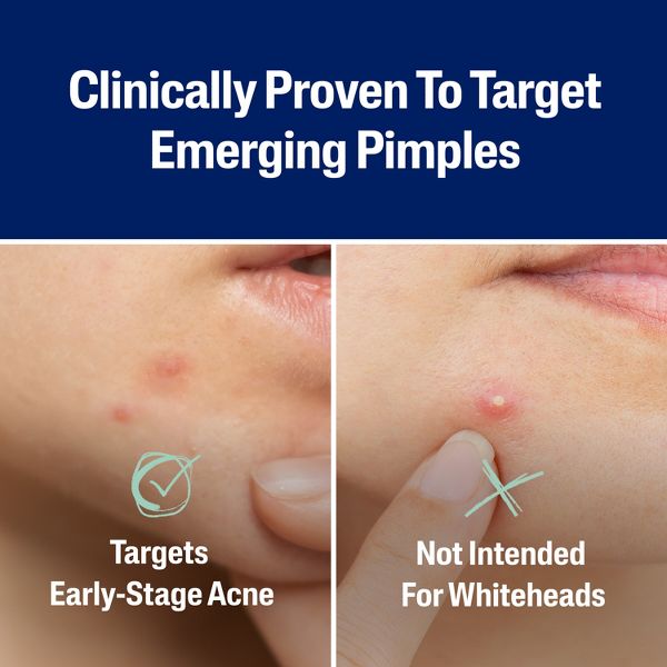 Cetaphil Acne Spot Pimple Patches with Salicylic Acid - 24ct‚Äã